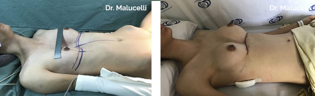P. Excavatum + Aumento do volume das cabeças das clavículas + Elevação do manúbrio esternal + Mamas pequenas e com ptose (abaixamento) de mamas + Elevação dos rebordos costais (transição entre o tórax e o abdomem)